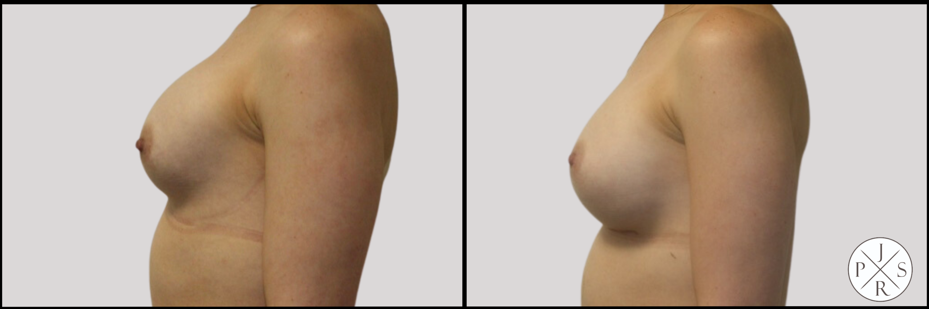 Breast Revision Before & After Image